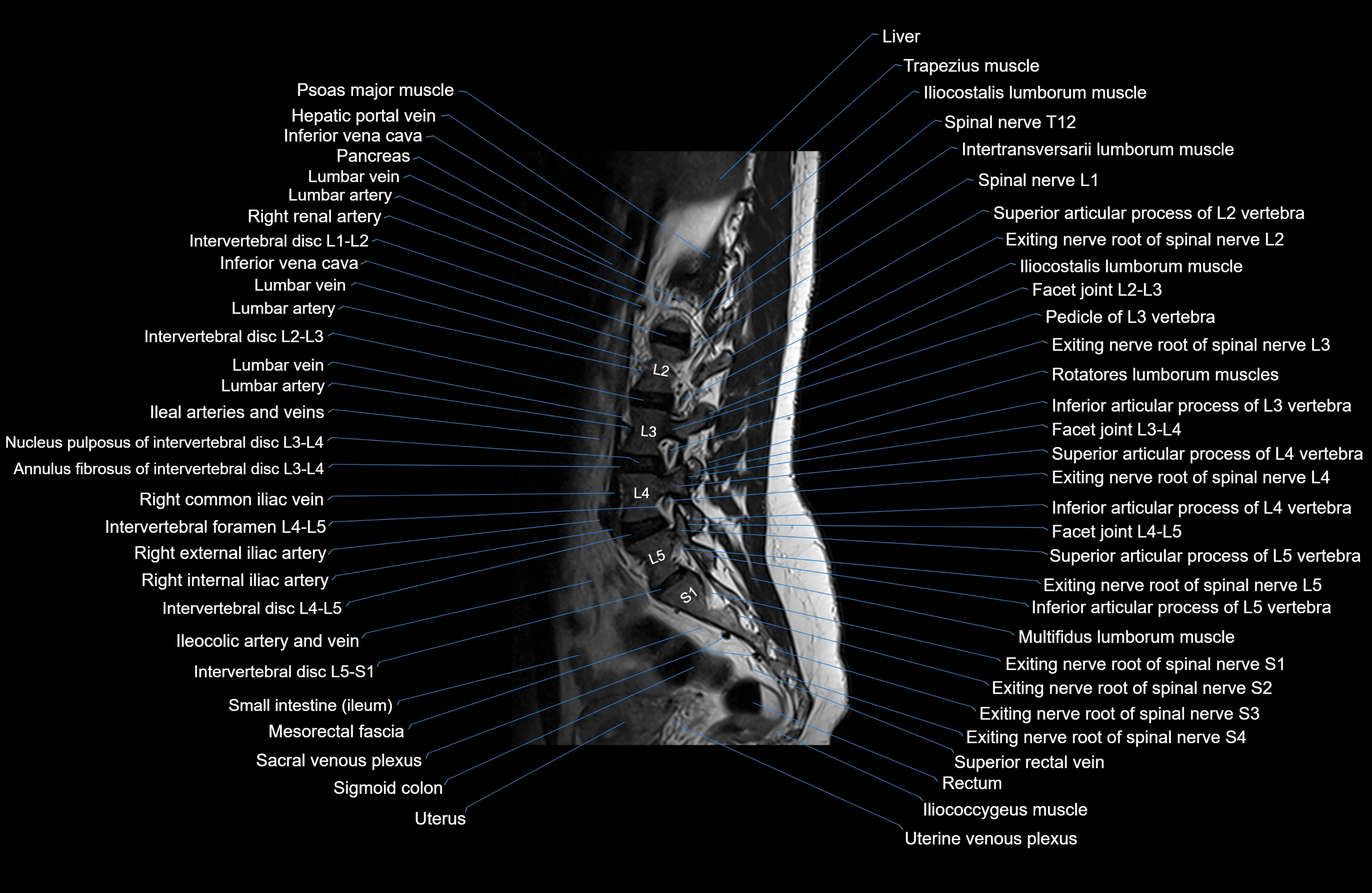 MRI lumbar spine sagittal cross sectional anatomy 3T radiology  image-img-00001-00007.webp